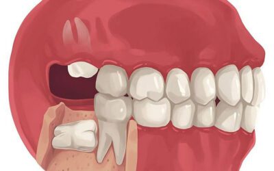 Too few teeth “Wisdom” teeth in dogs and cats
