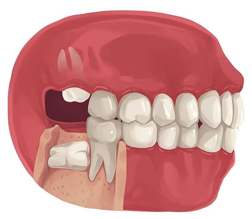 Diagram of a jaw showing a missing tooth Diagram of a jaw showing a missing tooth